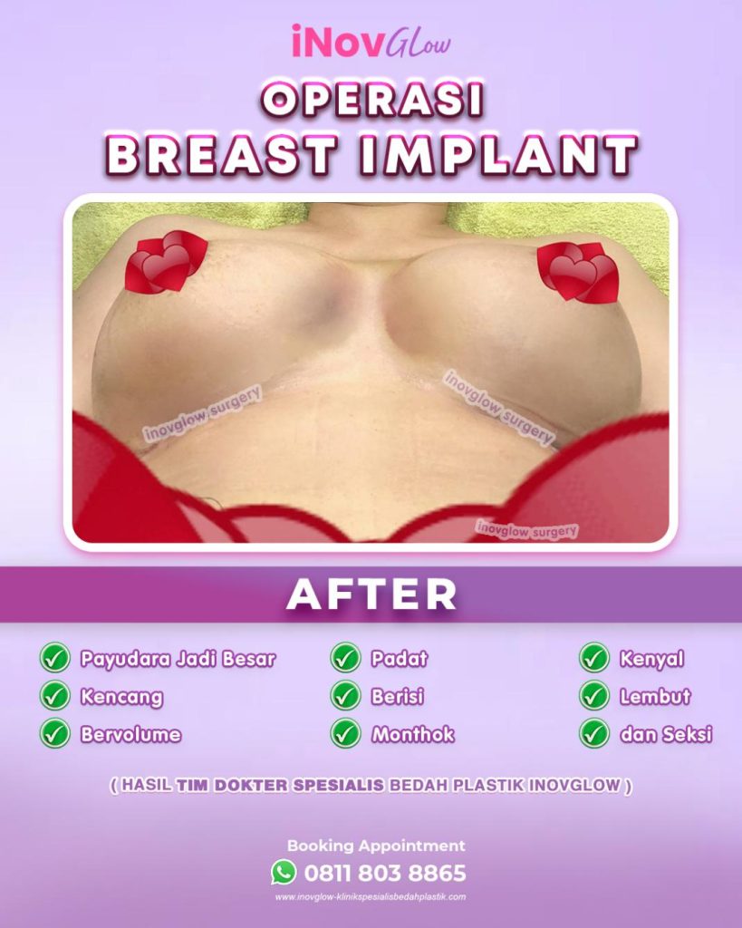 Apakah ada batasan usia untuk prosedur Breast Lift? 🤔 Faktanya, elastisitas kulit berubah seiring bertambahnya usia. Memahami 'kapan' melakukan prosedur adalah kunci hasil yang natural dan tahan lama.
🔍 Cek faktanya di artikel: Panduan Usia Ideal Pengencangan Payudara.
Percayakan prosedur bedah plastik Anda pada dr. Heri Noviana, SpBP, RE-M.Ked.Klin.
