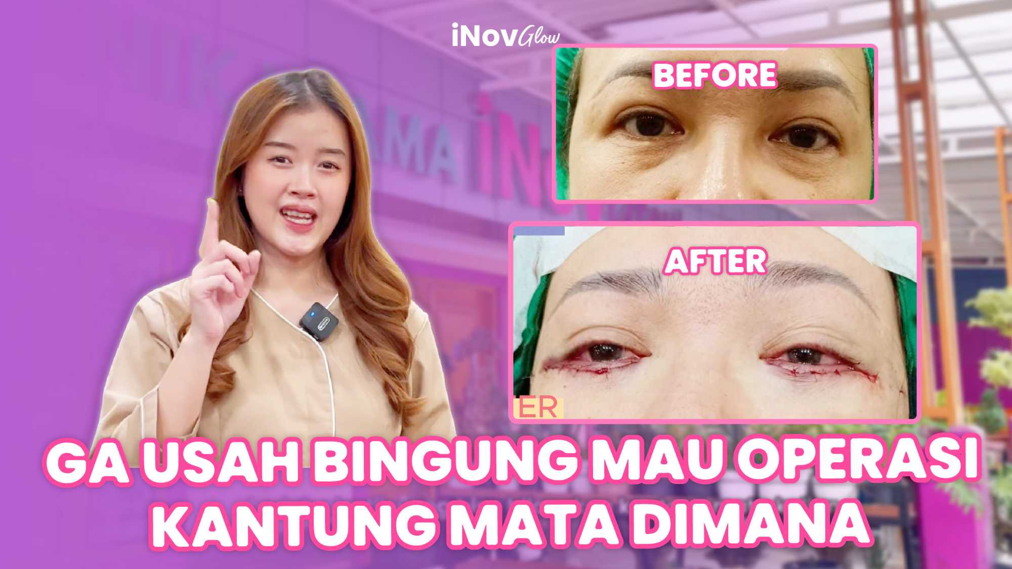 Hapus Mata Panda & Kerutan Secara Permanen! ✨
Bosan terlihat lelah meski sudah cukup tidur? Operasi kelopak mata bawah bisa jadi solusinya. Cari tahu efektivitasnya langsung dari pakarnya, dr. Heri Noviana, SpBP-RE, M.Ked.Klin.
👉 Baca selengkapnya di sini