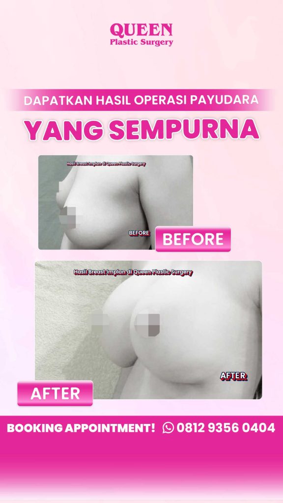 Kembalikan pancaran percaya diri Anda! ✨ Temukan cara efektif meraih kembali body goals pasca persalinan melalui prosedur Mommy Makeover yang dipersonalisasi. Konsultasikan transformasi Anda bersama dr. Heri Noviana, SpBP-RE, M.Ked.Klin.
