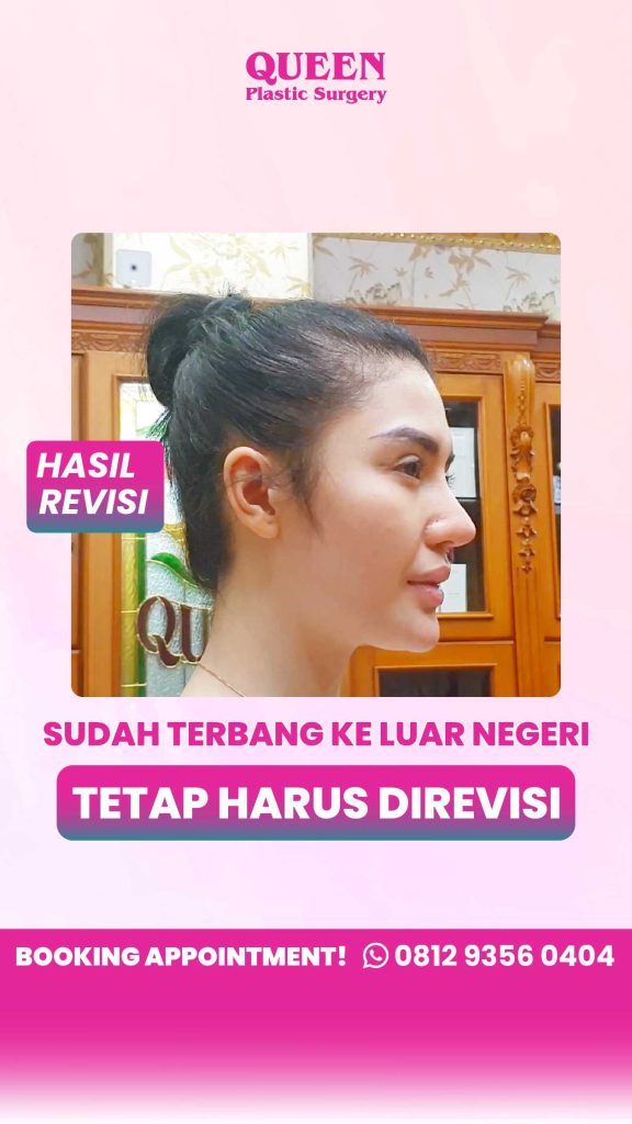 Hidung mancung impian: Implan silikon atau tulang rawan sendiri? 🤔 Jangan sampai salah pilih augmentasi rhinoplasty sebelum baca perbandingannya di sini! Konsultasikan pilihan terbaikmu dengan ahlinya, dr. Heri Noviana, SpBP-RE.M.Ked.Klin."+
👉 Klik untuk cek perbedaannya!