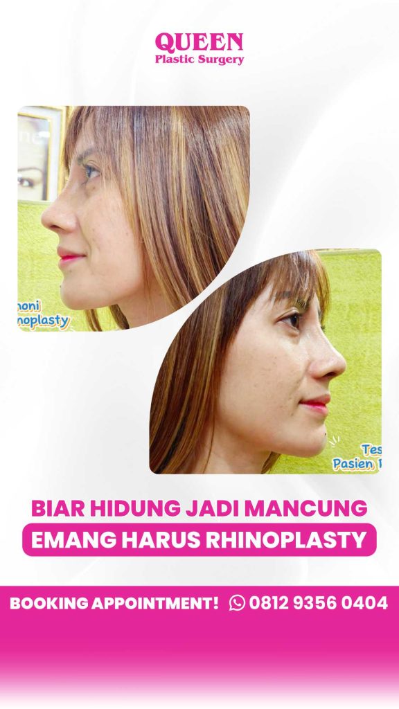 Jangan asal pasang implan! 🛑 Ketahui kelebihan dan risiko menggunakan tulang rawan vs implan untuk hasil augmentasi Rhinoplasty yang natural dan tahan lama. Pastikan Anda ditangani oleh dr. Heri Noviana, SpBP-RE.M.Ked.Klin.
👉 Pelajari prosedurnya sekarang