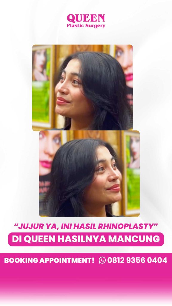 Definisi hidung ideal ada di artikel ini! 👃 Temukan bagaimana implan silikon & tulang rawan bekerja sama. Tanya dr. Heri Noviana, SpBP-RE.M.Ked.Klin untuk jadwal Anda.