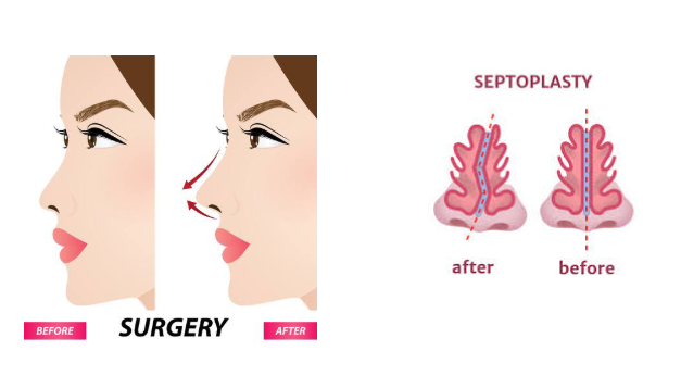 Tahukah Anda? Septoplasty fokus memperbaiki sekat hidung yang miring (deviated septum), sedangkan Rhinoplasty fokus pada penampilan luar hidung. 🩺 Tapi kabar baiknya, keduanya bisa dilakukan bersamaan, lho! ✨
🔗 Pelajari perbedaannya lebih lanjut di bio!
Dapatkan hasil yang fungsional sekaligus estetik dari dr. Heri Noviana, SpBP, RE-M.Ked.Klin.