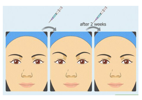 Mengapa Alis Spock bisa terjadi setelah suntik Botox? 💉 Hal ini biasanya terjadi karena otot dahi bagian samping bekerja terlalu keras sementara bagian tengah sedang 'istirahat'. Pahami anatomi wajah Anda agar hasil prosedur estetika tetap proporsional.
🔗 Baca artikel lengkapnya di bio!
Dapatkan penanganan profesional dari ahlinya: dr. Heri Noviana, SpBP, RE-M.Ked.Klin.