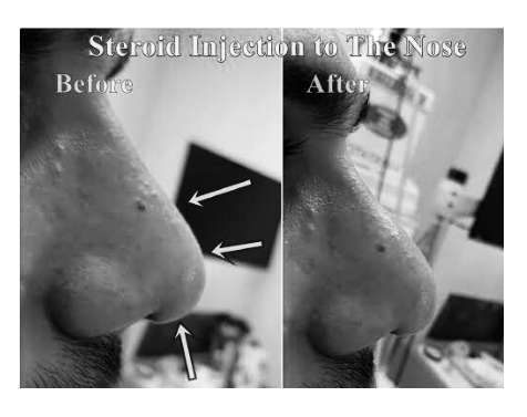 Solusi ampuh atasi bengkak membandel setelah operasi hidung! Suntik steroid bukan sekadar tren, tapi prosedur medis untuk hasil Rhinoplasty yang maksimal. Simak penjelasan lengkapnya di sini.
👉 Klik link di bio untuk jadwal konsultasi bersama dr. Heri Noviana, SpBP-RE.M.Ked.Klin.