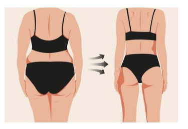Kembalikan rasa percaya diri dengan bentuk tubuh proporsional. 🌟
Liposuction bukan sekadar tren, tapi solusi medis untuk lemak tubuh yang sulit hilang. Simak panduan lengkapnya di artikel ini!
👉 Baca selengkapnya dan raih tubuh idealmu!