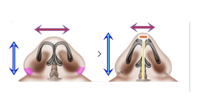 Hidung proporsional, kunci wajah lebih harmonis! Pilih Tip Plasty untuk fokus di ujung atau Rhinoplasty untuk hasil menyeluruh. Cari tahu pilihan terbaik untuk fitur wajah unikmu.
Klik di sini untuk jadwal konsultasi dengan dr. Heri Noviana, SpBP-RE.M.Ked.Klin.