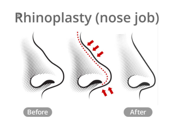Tip Plasty vs Rhinoplasty: Mana yang kamu butuhkan? Dapatkan jawaban medis yang tepat agar hasil operasi hidungmu tampak alami dan aman.
Hubungi dr. Heri Noviana, SpBP-RE.M.Ked.Klin untuk diskusi lebih lanjut!