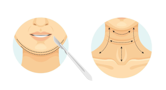 Double chin ganggu penampilan? Cari tahu solusi terbaik antara Liposuction atau Neck Lift untuk rahang yang lebih tegas. Konsultasikan pilihan prosedur Anda bersama dr. Heri Noviana, SpBP-RE.M.Ked.Klin.
👉 Klik link di bio untuk buat janji temu!