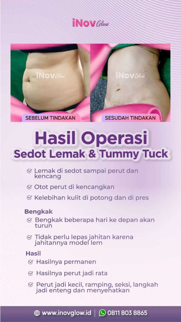 Jangan Salah Sangka Tentang Sedot Lemak! 🛑
Apakah sedot lemak bisa menyembuhkan sindrom metabolik secara total? Jawabannya mungkin mengejutkan Anda. Simak ulasan lengkapnya berdasarkan tinjauan bedah plastik terkini.
👉 Cek faktanya di artikel ini!