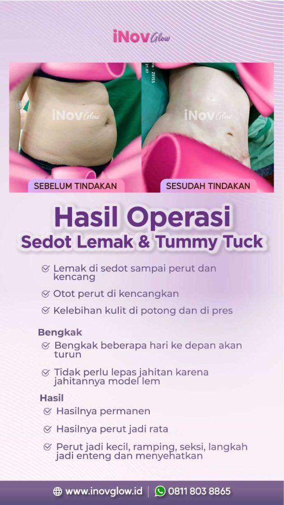Sedot Lemak: Estetika atau Kesehatan? 🩺
Sindrom metabolik adalah ancaman serius bagi tubuh. Pelajari apakah tindakan liposuction benar-benar bisa membantu penyembuhan bersama pakarnya, dr. Heri Noviana, SpBP-RE.M.Ked.Klin.
👉 Klik untuk jawaban medisnya!