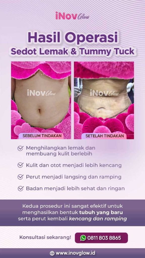 Ucapkan selamat tinggal pada lemak membandel! ✋
Kenali cara kerja Liposuction dalam membentuk tubuh idaman secara efektif dan aman. Simak penjelasan ahlinya sekarang.
👉 Baca artikelnya di sini!