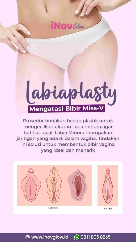 Memahami Prosedur Labioplasty untuk Meningkatkan Kenyamanan dan Kepercayaan Diri dalam Kehidupan Seksual