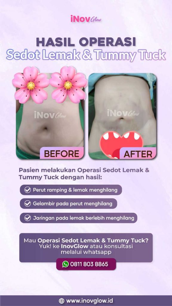 Fakta Sedot Lemak & Sindrom Metabolik. 🧬
Bukan sekadar mengecilkan perut, cari tahu apakah prosedur ini berdampak pada kesehatan metabolisme Anda. Temukan panduan lengkapnya di artikel terbaru kami!
👉 Baca sekarang!