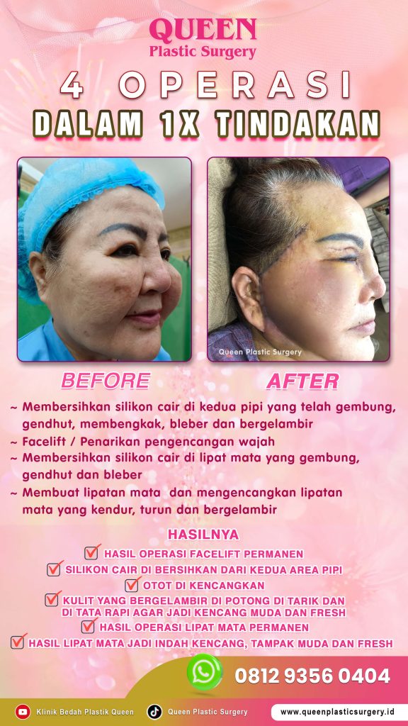 Neck Lift vs Sedot Lemak Leher: Mana yang Anda Butuhkan? Dapatkan informasi akurat mengenai prosedur bedah plastik leher untuk hasil yang aman dan estetik.

Tanya dr. Heri Noviana, SpBP-RE.M.Ked.Klin via WhatsApp sekarang!