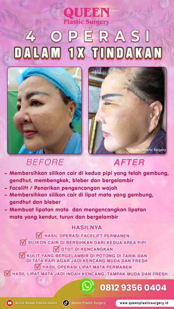 Kulit Kendur atau Hanya Lemak Berlebih? Mengetahui perbedaan antara operasi pengencangan dan sedot lemak leher bisa menghemat waktu dan biaya Anda. Pastikan Anda mendapatkan tindakan yang tepat.

Konsultasikan dengan dr. Heri Noviana, SpBP-RE.M.Ked.Klin.
