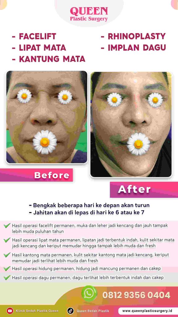 Kelopak mata kendur bikin wajah tetap lelah meski sudah Facelift? Ini solusi jitu dari dr. Heri Noviana, SpBP-RE.M.Ked.Klin.