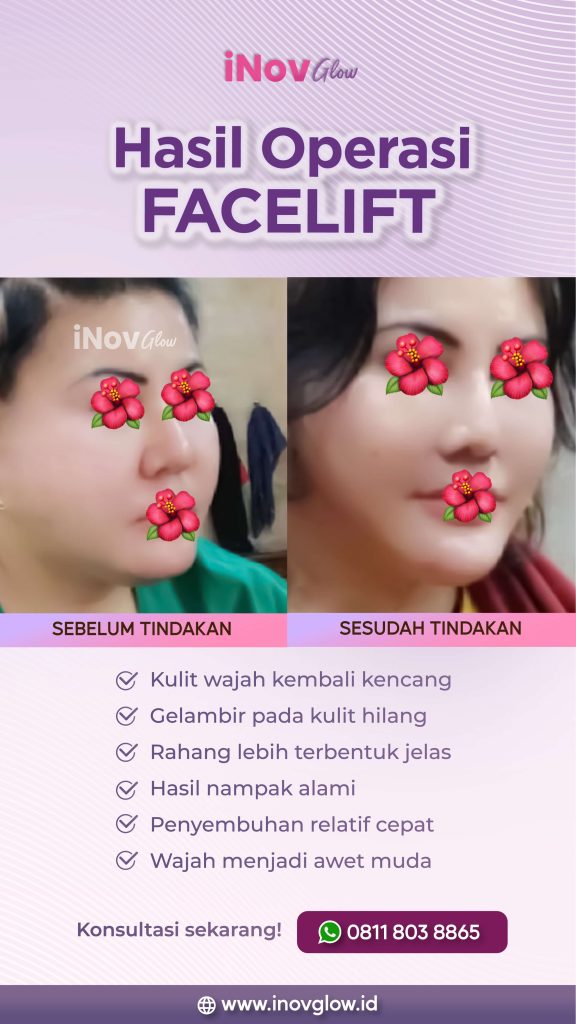 Hasil facelift tampak aneh dan tidak proporsional? Kembalikan kepercayaan diri Anda dengan penanganan profesional dari spesialis bedah plastik terpercaya.
Segera hubungi dr. Heri Noviana, SpBP-RE.M.Ked.Klin untuk evaluasi medis.