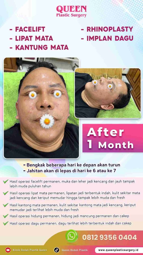 Wajah tirus tapi kelopak mata kendur? 📉 Simak cara sinkronisasi Facelift dan area mata agar hasil maksimal dan natural!