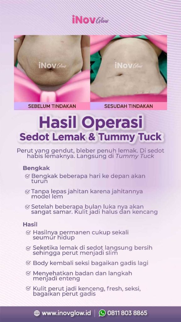 Lemak membandel susah hilang? Liposuction solusinya.
Jangan sembarang pilih prosedur. Pahami metode terbaik untuk mendapatkan lekuk tubuh impian langsung dari pakarnya, dr. Heri Noviana, SpBP-RE.
👉 Cek detail prosedurnya sekarang!