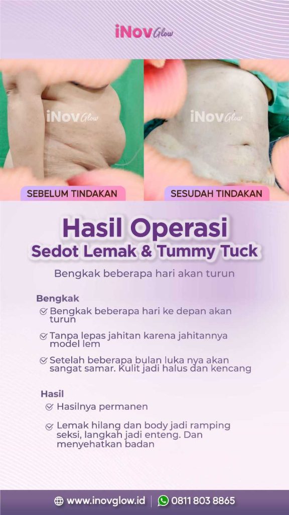 Apa itu Liposuction dan apakah aman untuk Anda?
Temukan jawaban lengkap mengenai metode penghilang lemak terbaik untuk hasil yang natural dan proporsional. Konsultasikan langkah Anda dengan dr. Heri Noviana, SpBP-RE.
👉 Pelajari selengkapnya di web kami!
