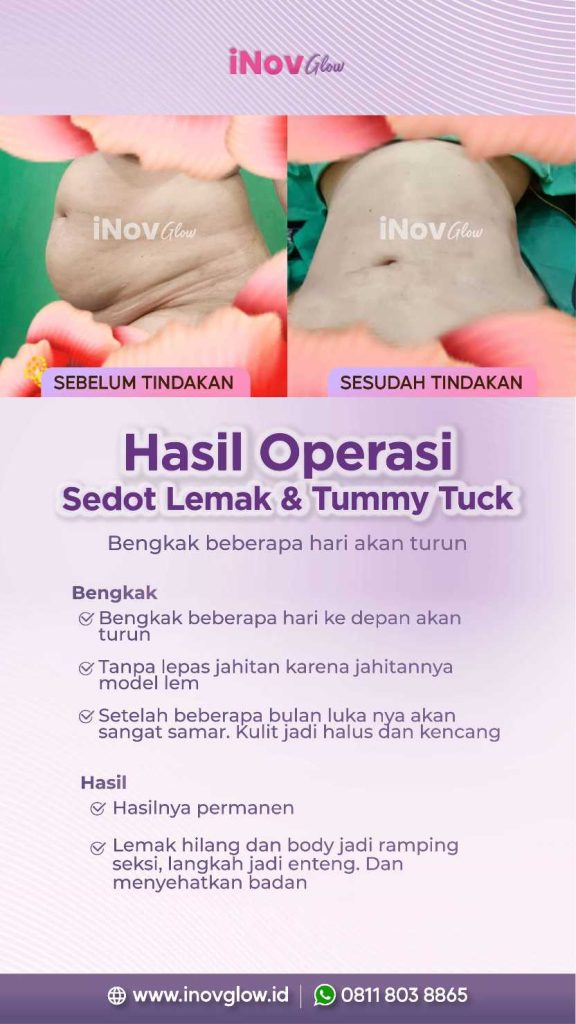 Ingin tubuh ideal dengan hasil nyata? 💃
Liposuction hadir sebagai metode penghilang lemak yang efisien. Pelajari prosedur dan manfaatnya di artikel terbaru kami.
👉 Klik untuk baca artikel lengkapnya!