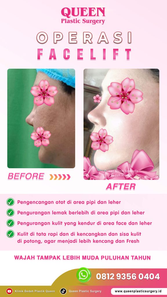 Ucapkan selamat tinggal pada pipi kendur! 👋 Teknik Facelift SMAS angkat jaringan dari dalam. Cek penjelasan dr. Heri Noviana, SpBP.RE-M.Ked.Klin di sini!