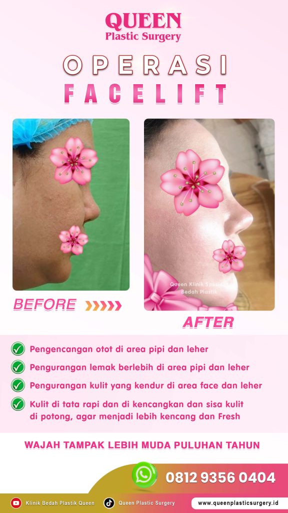 Kembalikan kencangnya kulitmu 15 tahun lebih muda! 💎 Tanpa efek wajah kaku, Facelift SMAS adalah solusinya. Konsultasi dengan dr. Heri Noviana, SpBP.RE-M.Ked.Klin hari ini.