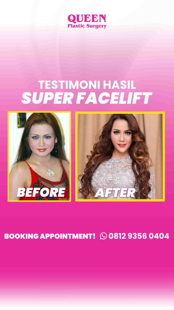 Mau awet muda 10 tahun lebih lama dengan satu kali tindakan? 🌟 Simak rahasia Facelift yang tidak bisa diberikan Dermal Filler. Konsultasi: dr. Heri Noviana, SpBP-RE.M.Ked.Klin.