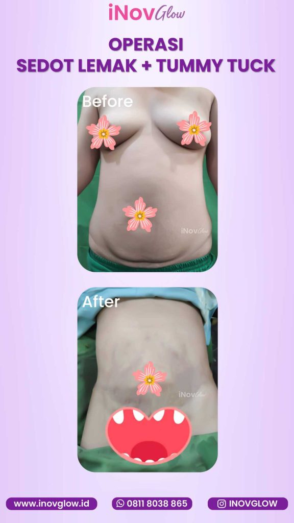 Ingin Sehat Sekaligus Ideal? ✨
Memahami kaitan antara lemak tubuh dan sindrom metabolik sangat penting sebelum Anda memulai prosedur bedah. Konsultasikan langkah tepat Anda bersama dr. Heri Noviana, SpBP-RE.M.Ked.Klin.
👉 Pelajari detailnya di sini!