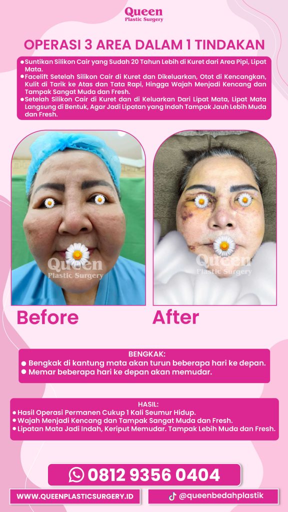 Perbandingan jujur: Facelift SMAS vs Deep Plane. Mana yang Anda butuhkan? 💎 Tanya dr. Heri Noviana, SpBP-RE.M.Ked.Klin hari ini!