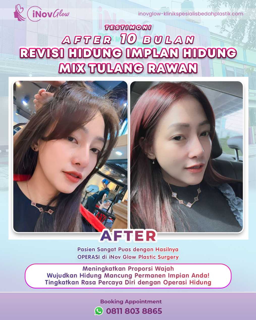 Hasil Rhinoplasty anti-geser? Ini rahasia material bahan rhinoplasty! 🤫 Baca selengkapnya di artikel terbaru dr. Heri Noviana.