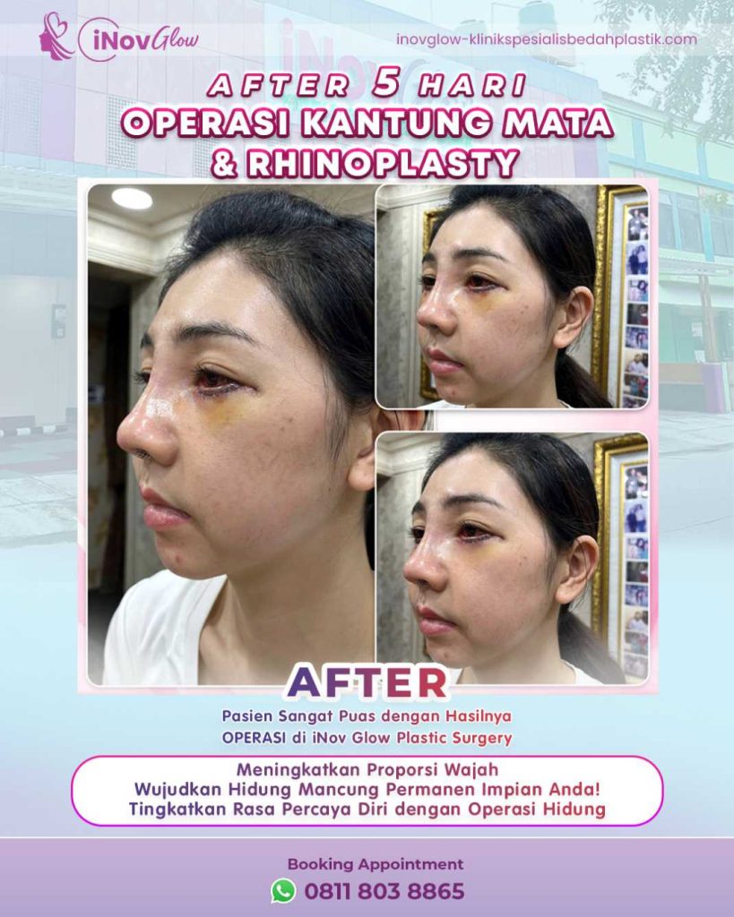 Pemulihan tepat, hasil hebat. Suntik steroid pasca Rhinoplasty adalah prosedur umum di bawah pengawasan ahli. Pastikan kamu mendapatkan penanganan yang benar dari pakarnya.
👉 Percayakan hasil operasimu pada dr. Heri Noviana, SpBP-RE.M.Ked.Klin. Hubungi kami hari ini!