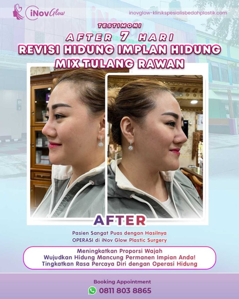 Bengkak Rhinoplasty tak kunjung hilang? Suntik steroid bisa jadi solusinya! Pelajari prosedur, manfaat, dan faktanya di artikel ini. 📑
👉 Dapatkan saran medis terbaik dari dr. Heri Noviana, SpBP-RE.M.Ked.Klin di sini.