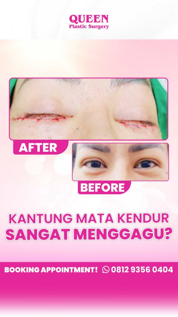 Solusi Awet Muda dari Pakarnya. Ingin hasil Operasi Kelopak Mata yang natural dan aman? Percayakan pada dr. Heri Noviana, SpBP-RE. Estetika presisi untuk hasil yang maksimal.
👉 Pelajari prosedur Blepharoplasty selengkapnya di artikel ini.