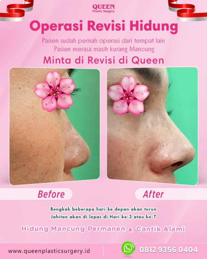 Ingin ujung hidung terlihat lebih proporsional tapi tetap natural? Teknik Tip Plasty adalah solusinya tanpa harus merombak seluruh struktur hidung. Serahkan pada ahlinya, dr. Heri Noviana, SpBP-RE.M.Ked.Klin.
👉 Klik di sini untuk lihat detail prosedurnya!
