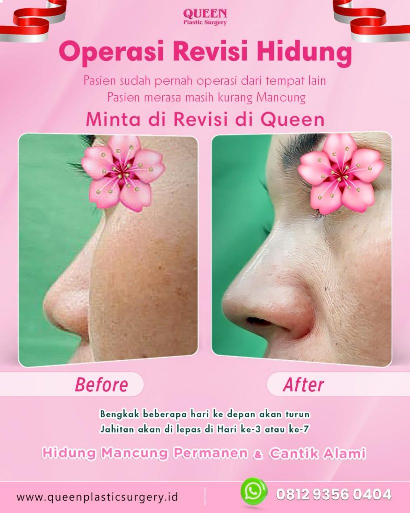 Sering kurang percaya diri dengan ujung hidung yang lebar? Tip Plasty hadir untuk memberikan kesan hidung lebih lancip dan tegas. Konsultasikan anatomi wajah ideal Anda bersama dr. Heri Noviana sekarang.
👉 Baca artikel lengkapnya yuk!