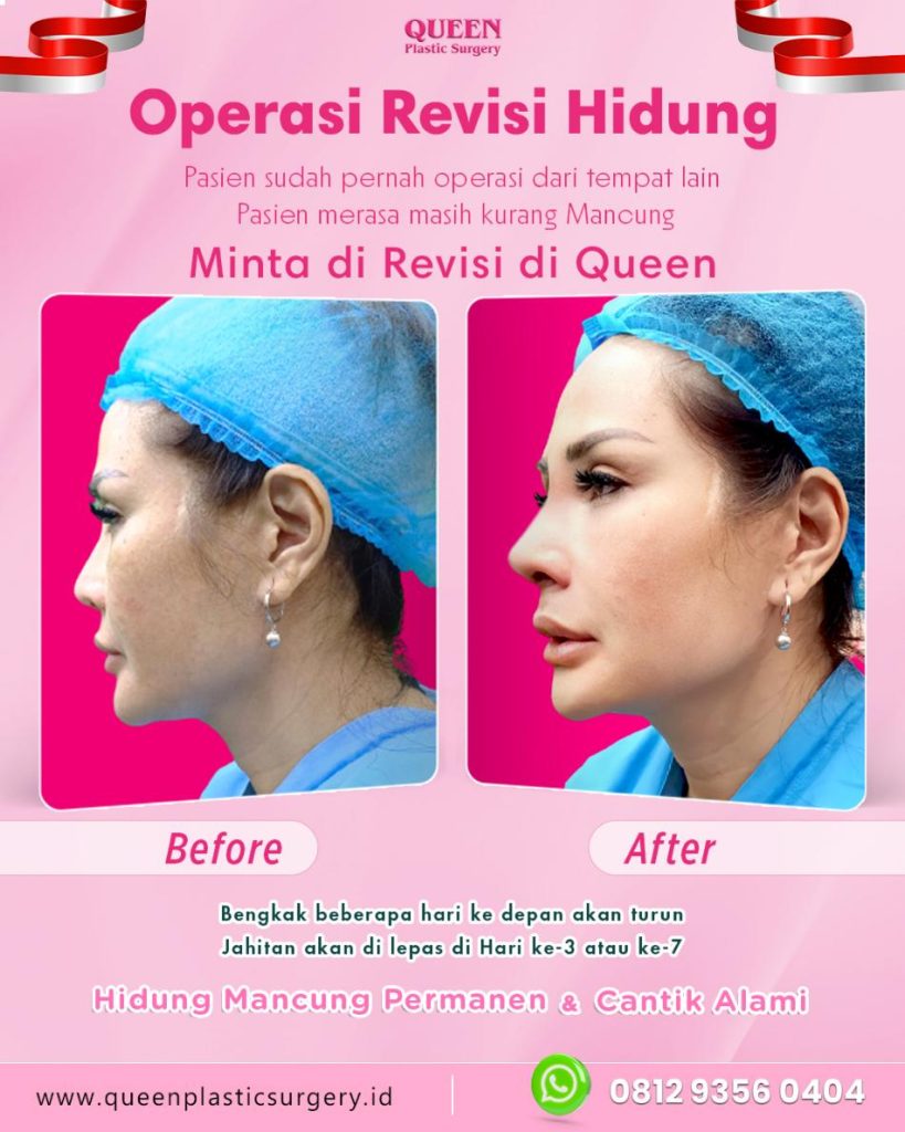 Apa rahasia hidung tampak lebih mancung tanpa operasi total? Jawabannya adalah Tip Plasty. Simak penjelasan dr. Heri Noviana, SpBP-RE.M.Ked.Klin mengenai teknik bedah minimal ini.
👉 Kepoin artikelnya di sini!