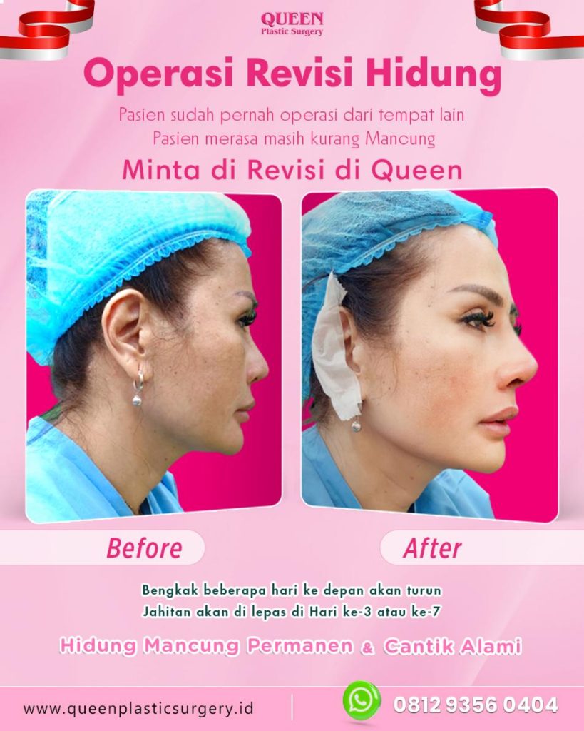 Tampil lebih berani dengan profil wajah impian. Jangan biarkan bentuk ujung hidung menghalangi rasa percaya diri Anda. Diskusi langsung dengan dr. Heri Noviana untuk solusi Tip Plasty terbaik.
👉 Klik untuk konsultasi pertama Anda!