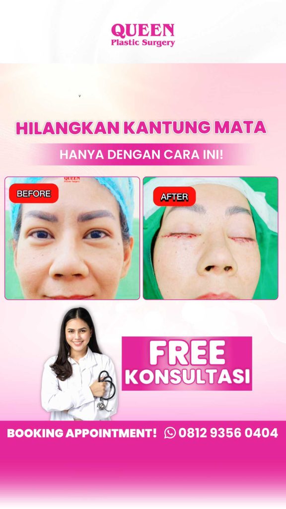 Hapus kerutan mata secara permanen! 👁️ Blepharoplasty bukan sekadar tren, tapi solusi medis untuk tampilan wajah yang lebih kencang dan awet muda.