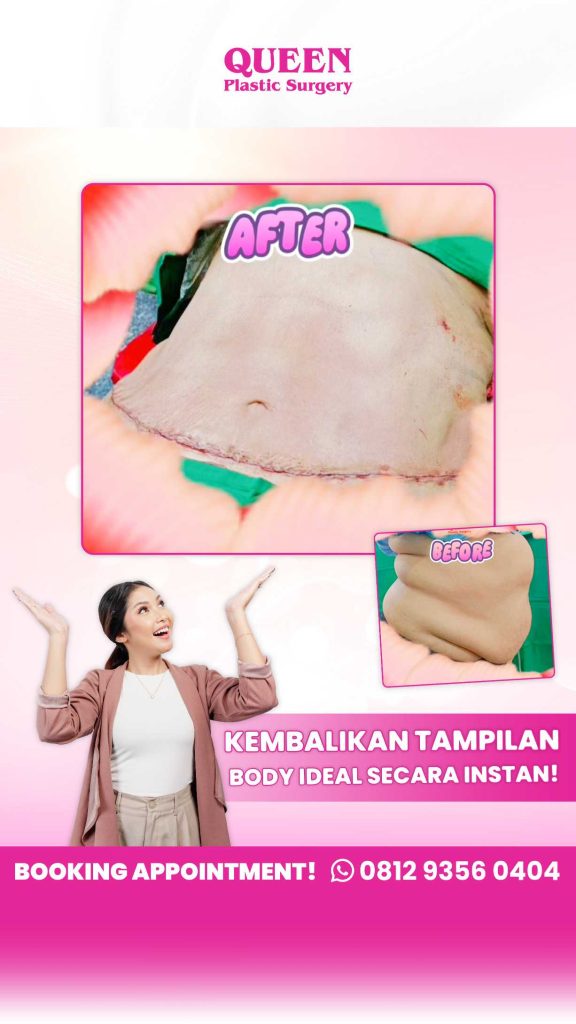 Kenapa hasil liposuction pada operasi pengencangan perut orang lain terlihat lebih lekuk? Mungkin mereka pakai teknik ini! 🤫 Simak penjelasan dr. Heri Noviana, SpBP-RE.M.Ked.Klin di artikel terbaru.
