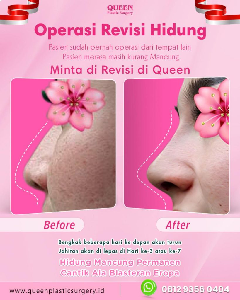 Mimpi punya hidung mancung alami? Ketahui apakah kamu hanya butuh perbaikan di area ujung (Tip Plasty) atau rekonstruksi penuh. Baca panduan lengkapnya di artikel ini!
Tanya langsung pada dr. Heri Noviana, SpBP-RE.M.Ked.Klin untuk hasil maksimal.