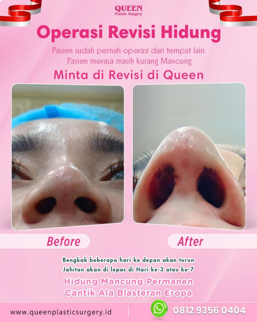 Sudah siap melakukan nose job tapi masih ragu soal metodenya? Bedah tuntas perbedaan Tip Plasty dan Rhinoplasty sebelum kamu mengambil keputusan besar.
Mulai konsultasi profesionalmu dengan dr. Heri Noviana, SpBP-RE.M.Ked.Klin.