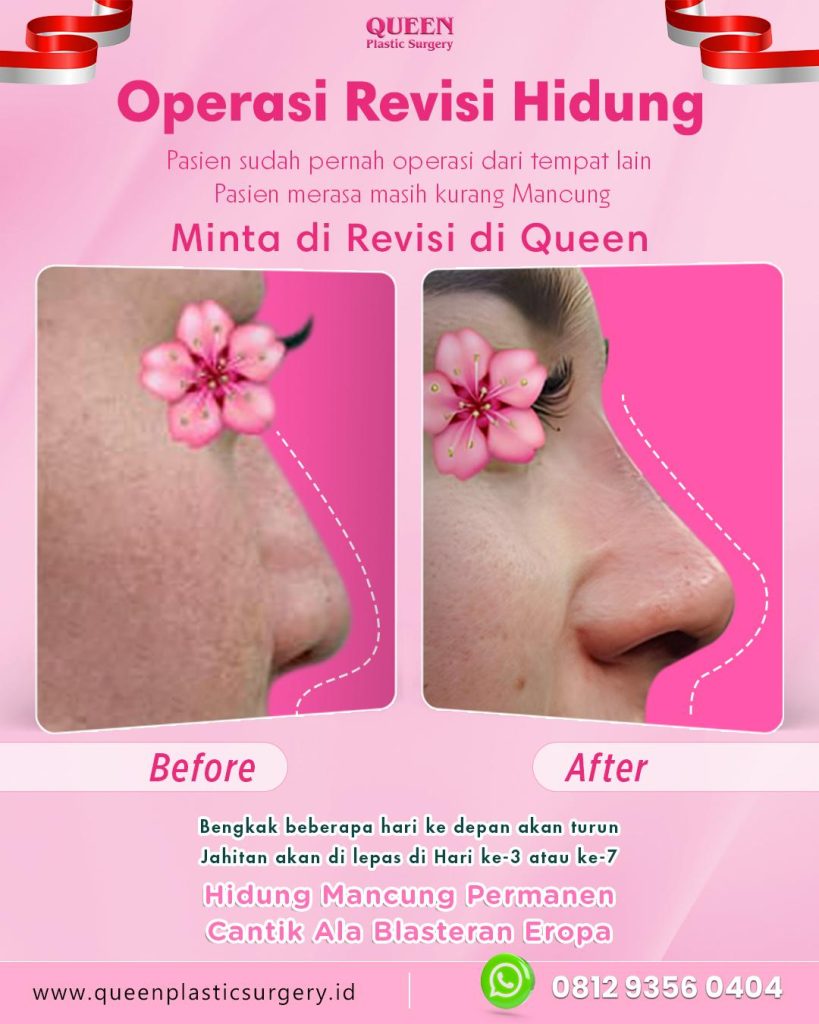 Ubah bentuk hidung bukan sekadar tren, tapi butuh keahlian bedah plastik yang presisi. Percayakan transformasi wajahmu pada ahlinya.
Booking sesi konsultasi Anda bersama dr. Heri Noviana, SpBP-RE.M.Ked.Klin hari ini.