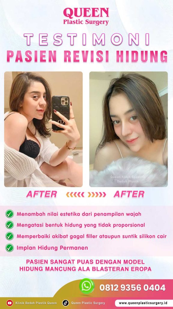 Upgrade profil wajah Anda agar lebih stunning dan simetris. Saatnya kenali prosedur Rhinoplasty lebih dekat bersama ahlinya, dr. Heri Noviana, SpBP-RE.M.Ked.Klin.
🚀 Lihat detail prosedurnya di web kami!