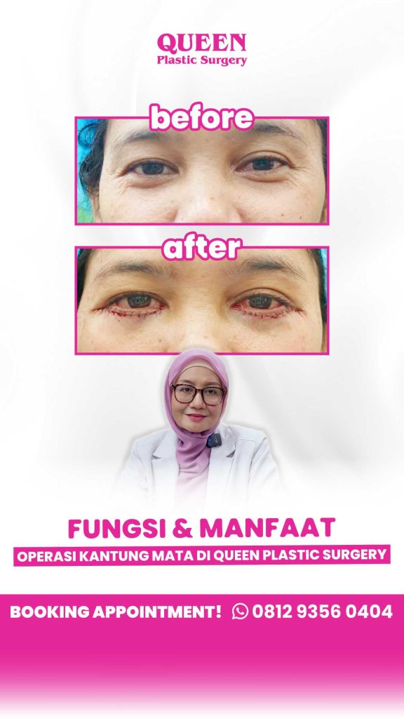 Jangan asal operasi kelopak mata! Cek dulu apakah kamu sebenarnya butuh Blefaroplasti dan Brow Lift. Konsultasikan dengan dr. Heri Noviana sekarang.