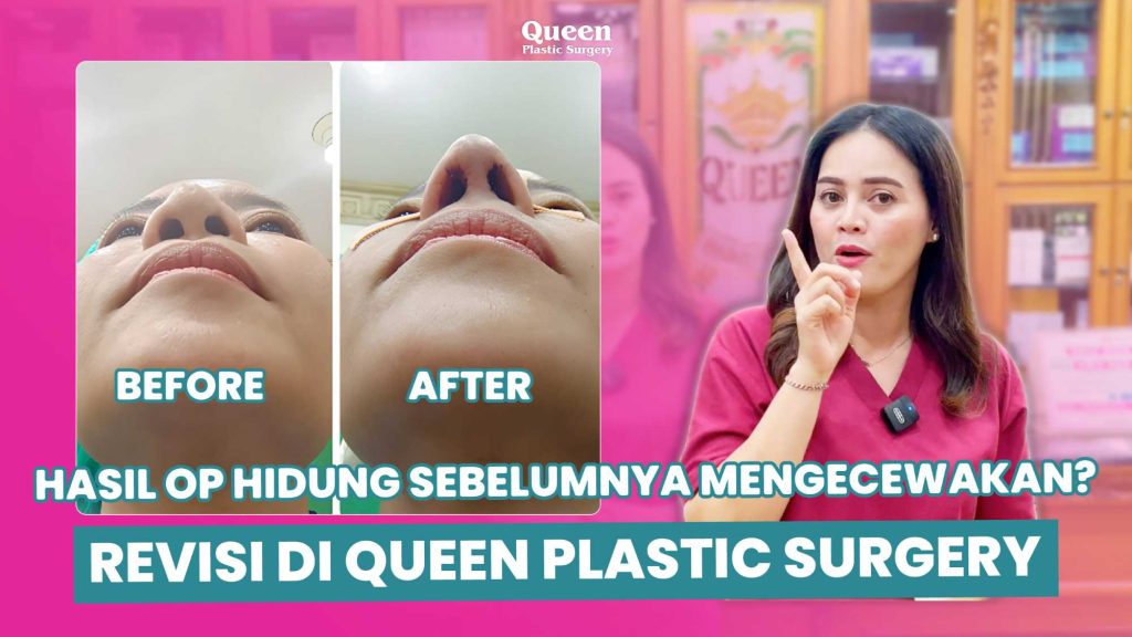 Sempurnakan siluet wajah dengan Tip Plasty. Prosedur minimal, hasil maksimal untuk ujung hidung bulat. Percayakan pada keahlian dr. Heri Noviana, SpBP-RE.M.Ked.Klin untuk hasil yang aman dan estetis.