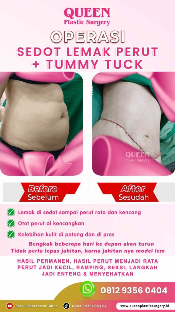 Lemak hilang, kulit kencang! ✨ Intip bagaimana Liposuction pada operasi pengencangan perut menyempurnakan bentuk tubuh Anda. Tanya dr. Heri Noviana, SpBP-RE.M.Ked.Klin untuk prosedur terbaik.