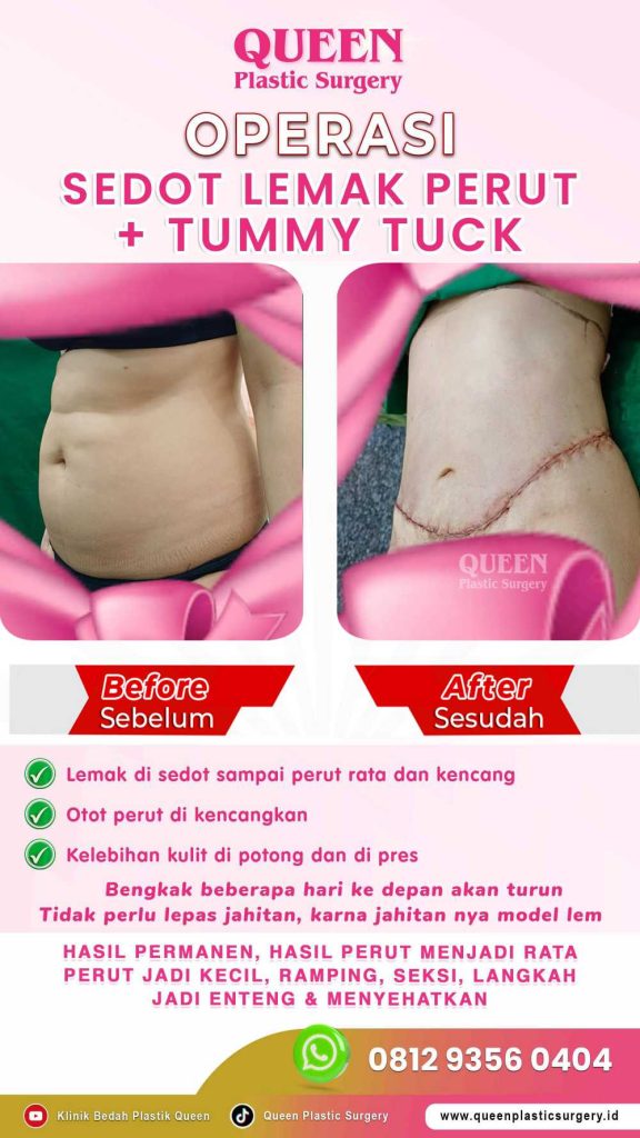 Liposuction pada Operasi Pengencangan Perut: Duet maut untuk body goals impian. 🏆 Temukan keunggulannya menurut dr. Heri Noviana, SpBP-RE.M.Ked.Klin di dalam artikel ini!