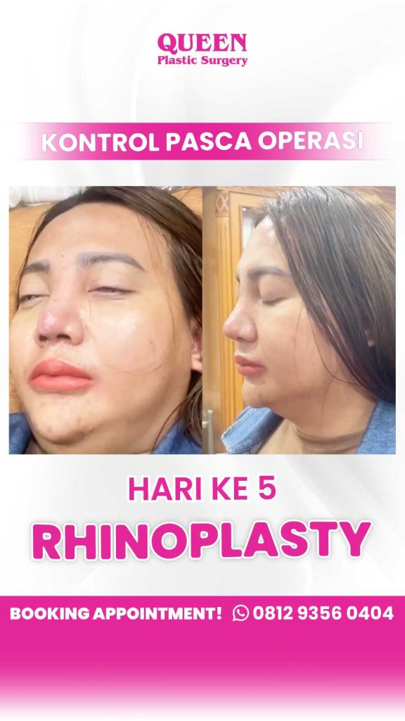 Stop Mendengkur dengan Prosedur Hidung yang Tepat! 🛑
Ingin napas lebih plong dan tidur tanpa gangguan? Konsultasikan masalah mendengkur Anda dengan dr. Heri Noviana, SpBP-RE, M.Ked.Klin. Solusi medis profesional ada di depan mata.
👉 Baca artikel selengkapnya